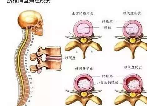 撕裂与重生，NBA 球员椎间盘突出真的普遍吗？